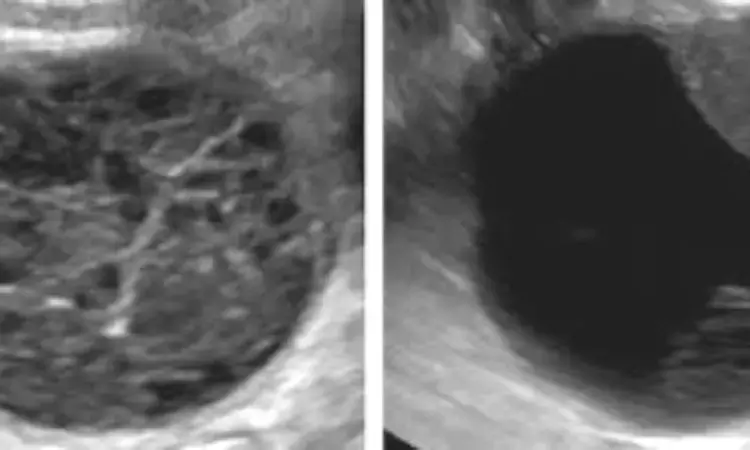 O-RADS MRI has high diagnostic performance for characterizing adnexal lesions: Study