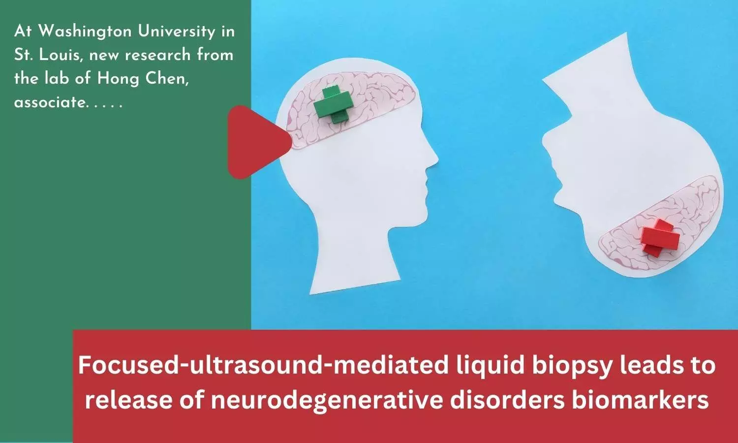 Focused-ultrasound-mediated liquid biopsy leads to release of neurodegenerative disorders biomarkers