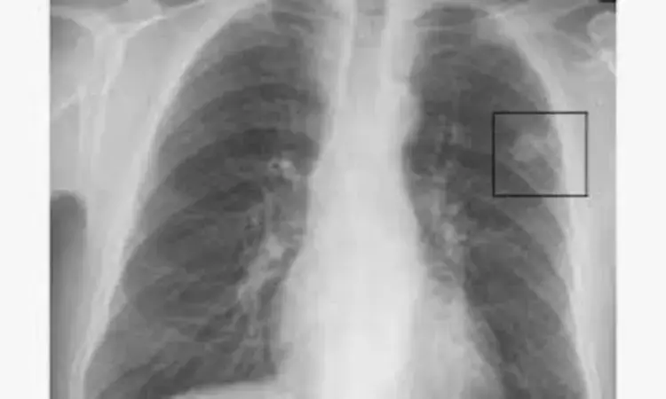 AI model may improve pulmonary nodule detection on chest radiograph: JAMA