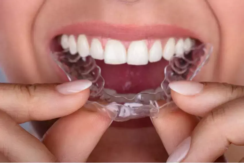 Increased Surface roughness and porosity of Directly printed aligners after 1 week of intraoral usage increases infection risk