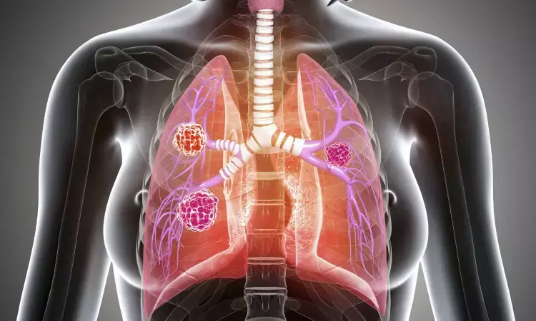 Ringlike peripheral high iodine concentration can differentiate lung cancer from pulmonary metastases: AJR