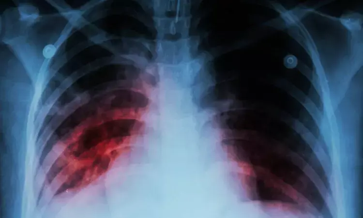 Pamrevlumab Shows No Significant Benefit in Slowing Lung Function Decline in Idiopathic Pulmonary Fibrosis: JAMA