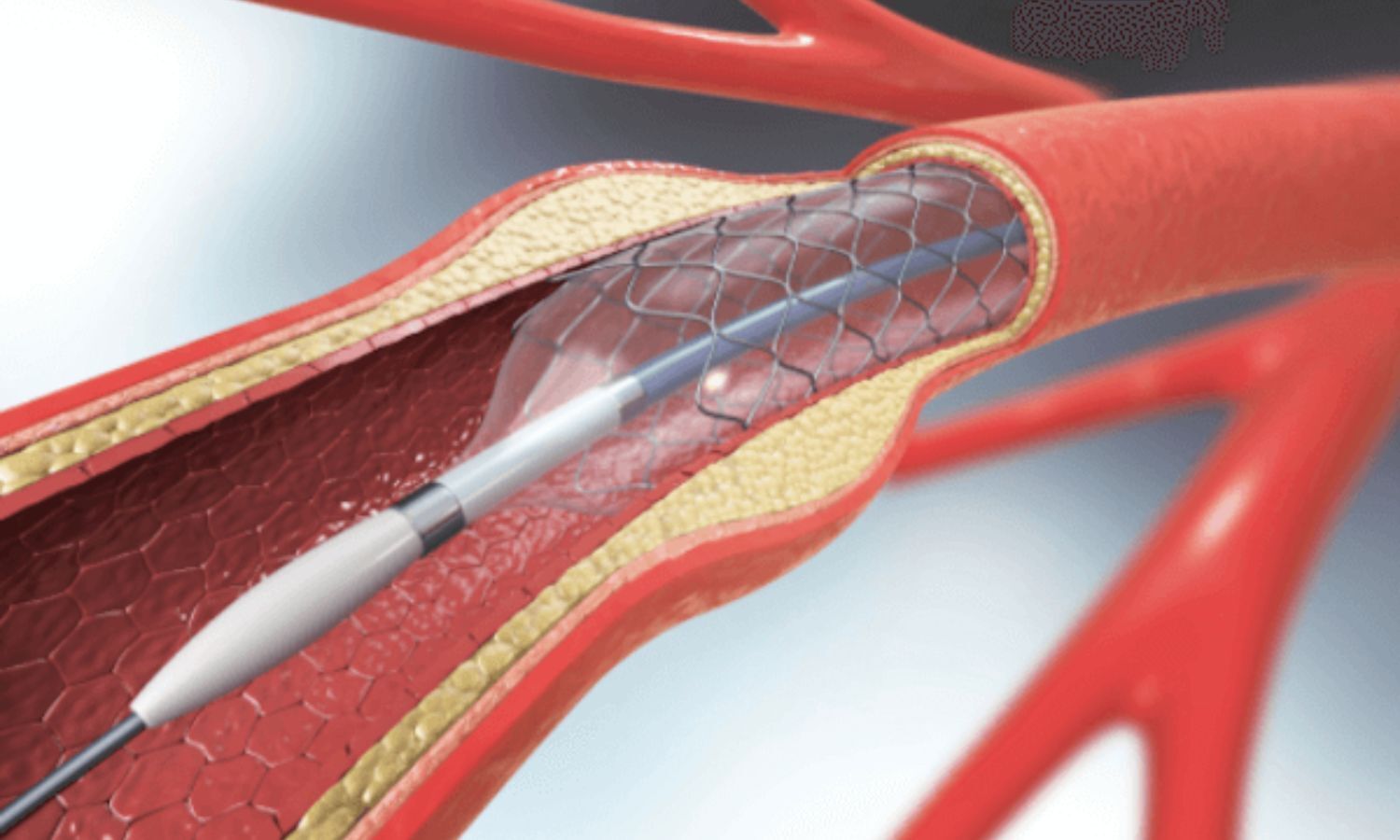 In-stent neoatherosclerosis frequent after endovascular therapy in ...