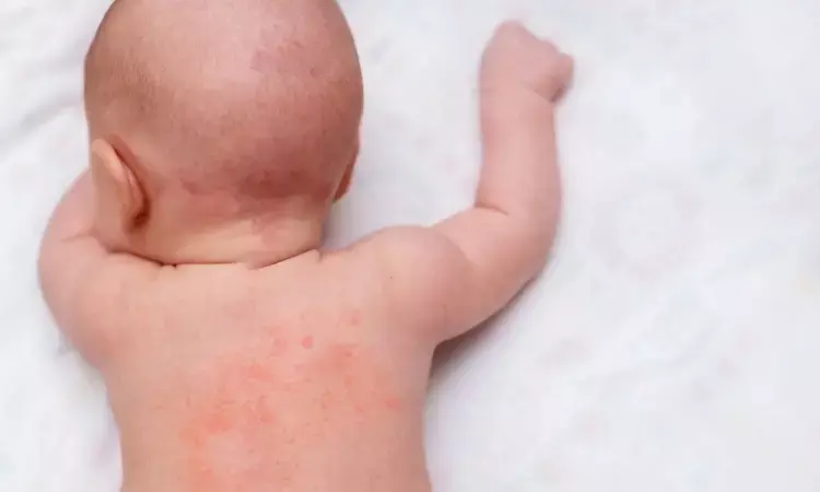 Cord Blood Levels of IL-31 and CCL17 and cutaneous markers may predict Atopic Dermatitis Risk in Infants: JAMA