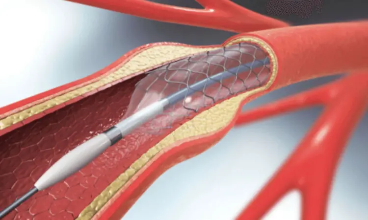 In-stent neoatherosclerosis frequent after endovascular therapy in lower limb arteries