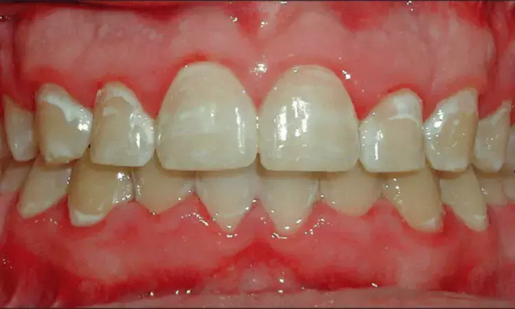 Bioactive glass remineralization therapy may reduce Post-orthodontic White Spot Lesions