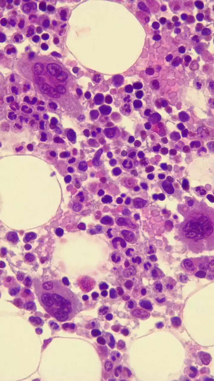 Know All About Bone Marrow Transplant