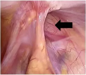 Right-side approach to enter Retzius space effective in laparoscopic TAPP bilateral inguinal hernia repair