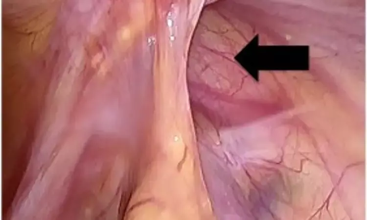 Right-side approach to enter Retzius space effective in laparoscopic TAPP bilateral inguinal hernia repair