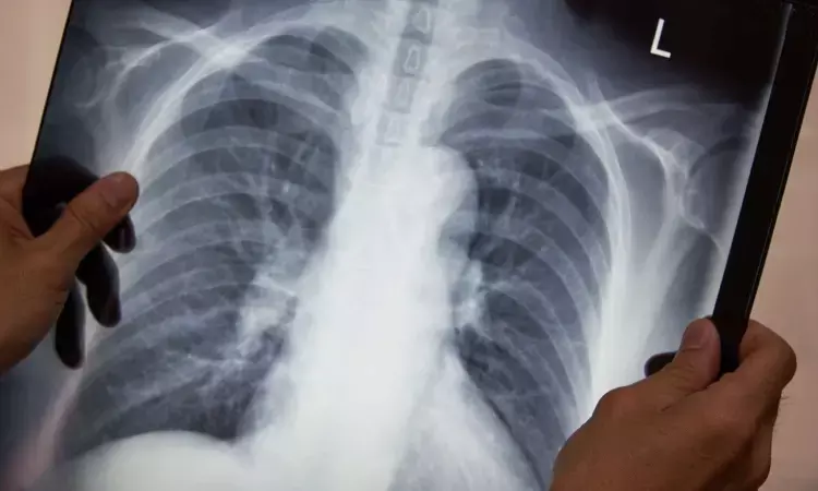 AI improves lung nodule detection on chest x-rays