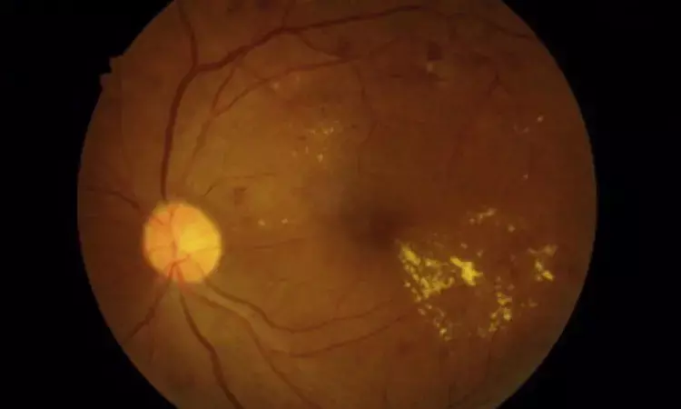 Allopurinol lowers risk of macular edema among diabetes patients