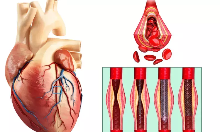 Coronary Arterial Aneurysms of   small size, recent onset and diagnosed under age of 1 year tend to regress