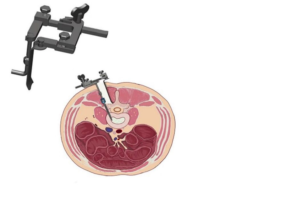 New automatic retraction device assisted unilateral TLIF surgery