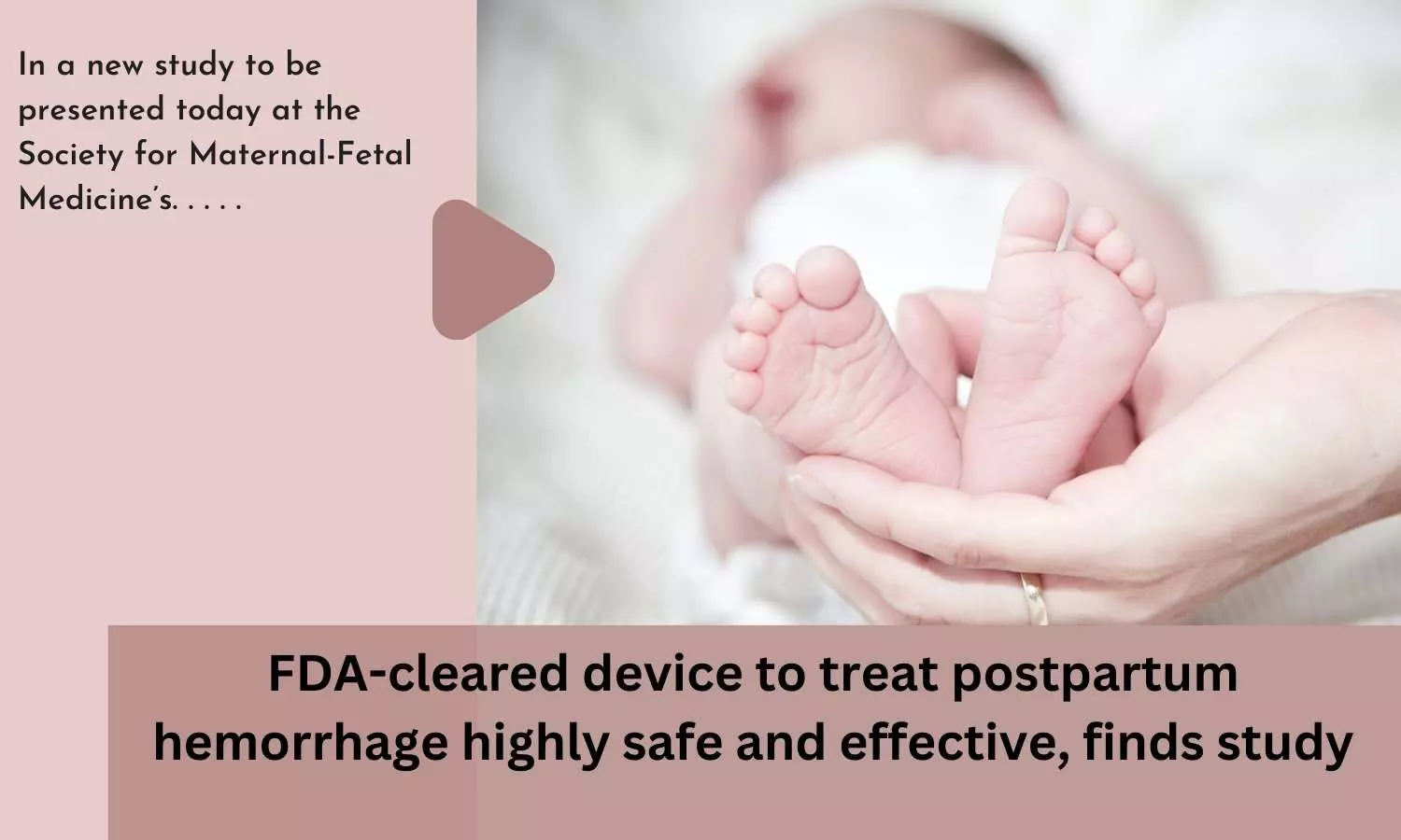 FDA-cleared device to treat postpartum hemorrhage highly safe and effective, finds study