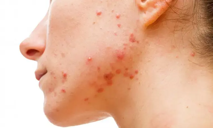 Higher incidence of acne among preadolescent girls linked to high BMI