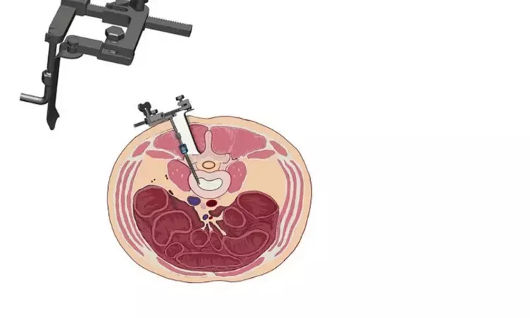 New automatic retraction device assisted unilateral TLIF surgery effectively treats single-level lumbar degenerative diseases