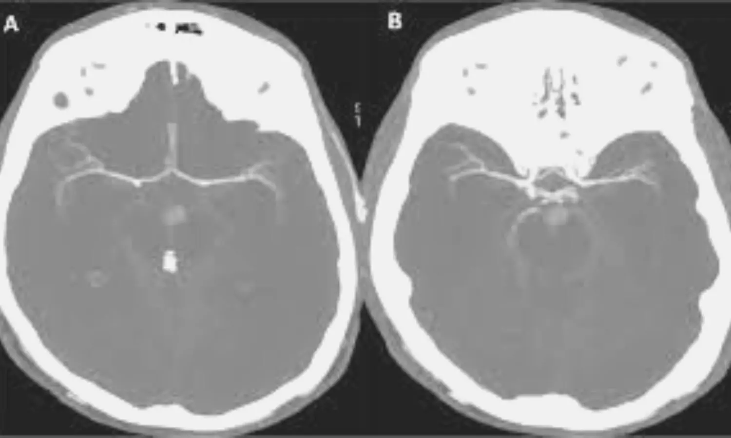 Use cerebral CT angiography to support clinical diagnosis of death using neurological criteria: Consensus statement