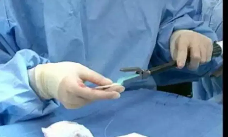 Does reinforced stapler use reduce pancreatic fistula rates during distal pancreatectomy?