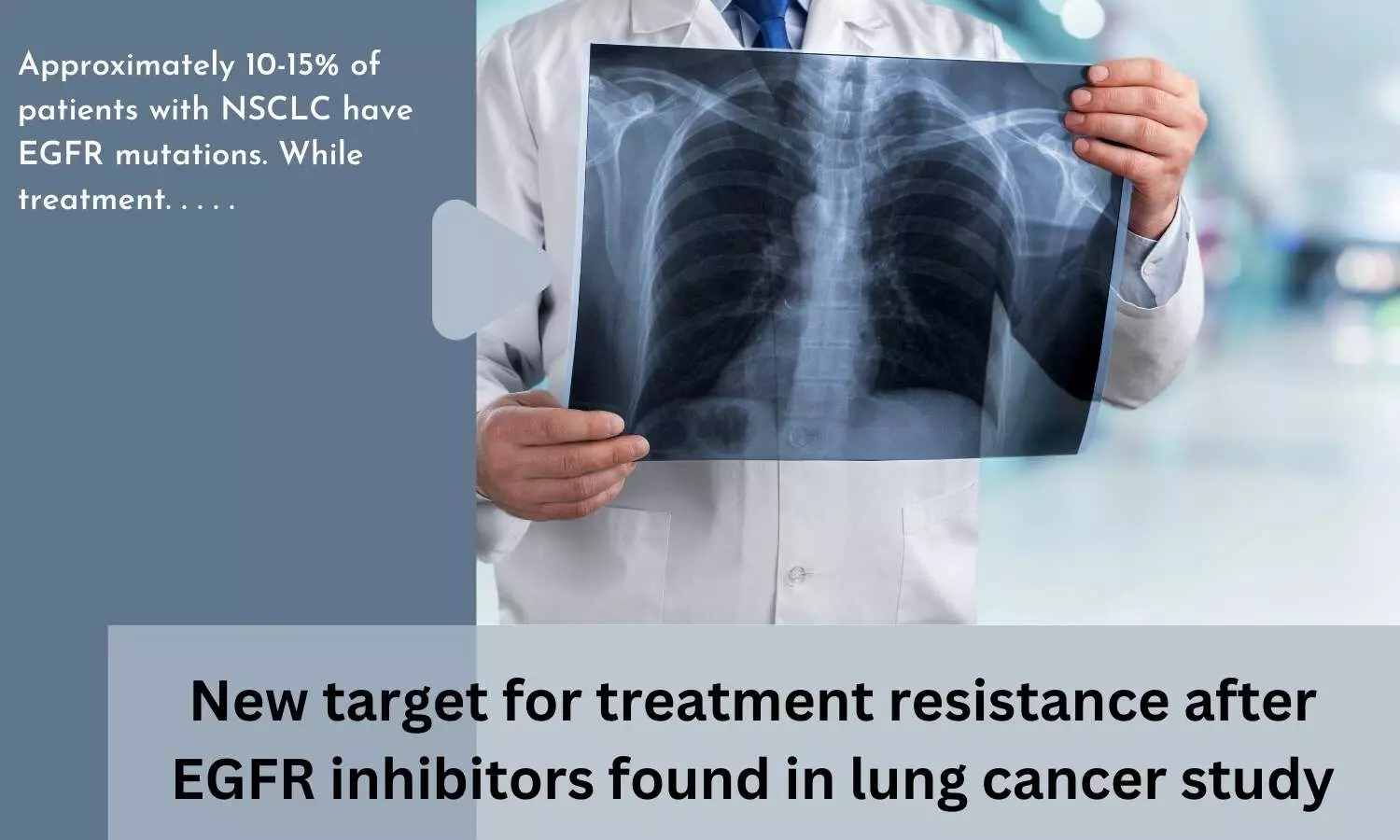 New target for treatment resistance after EGFR inhibitors found in lung cancer study