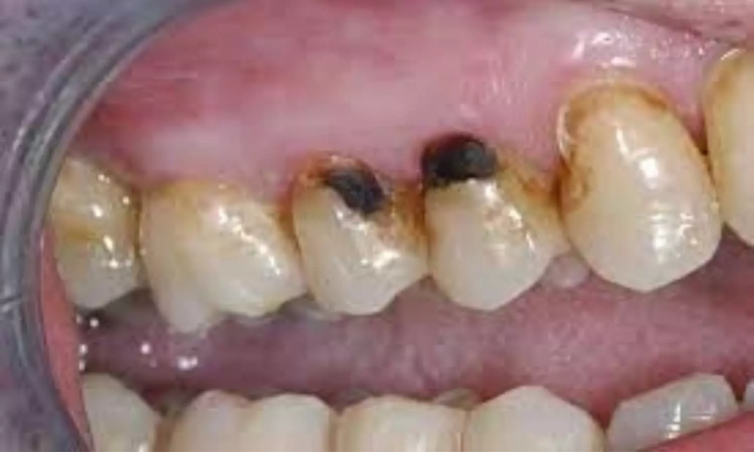 Permanent discolouration important barrier to acceptance of SDF treatment for visible root caries by elderly