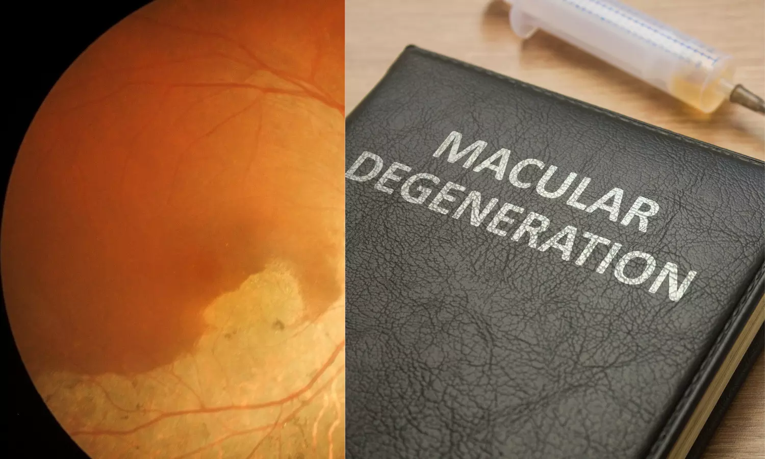 Increased intake of dietary calcium reduces risk of Age-related macular degeneration