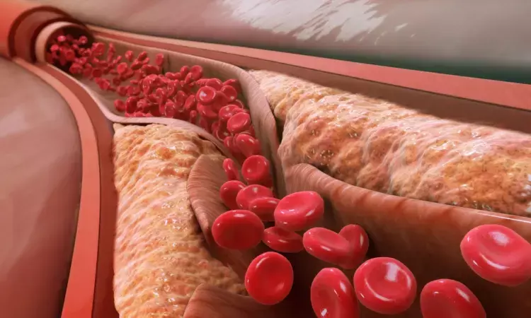 Cholesterol paradox- High LDL cholesterol level lowers mortality in non-diabetic HF patients