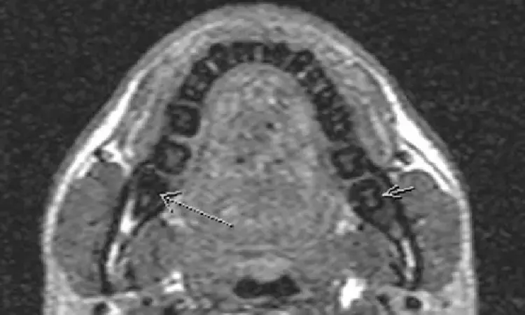 Magnetic resonance imaging benefits preoperative diagnosis in third molar surgery