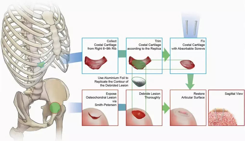 Autologous Costal Cartilage Grafting for Large Osteochondral Lesion of Femoral Head improves hip function and QoL