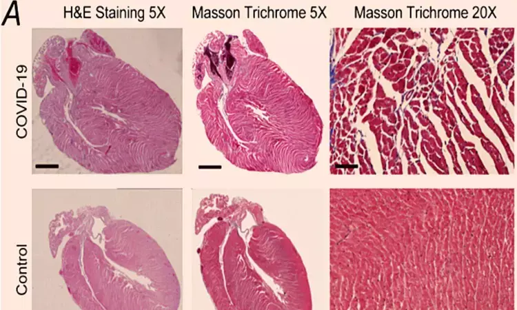 Can COVID-19 cause problems in the heart? Study provides insights