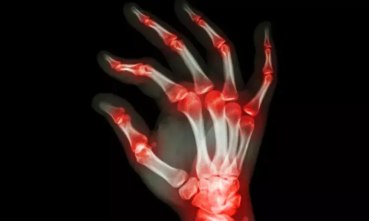 High sensitivity cardiac troponin levels tied to disease activity in inflammatory arthritis
