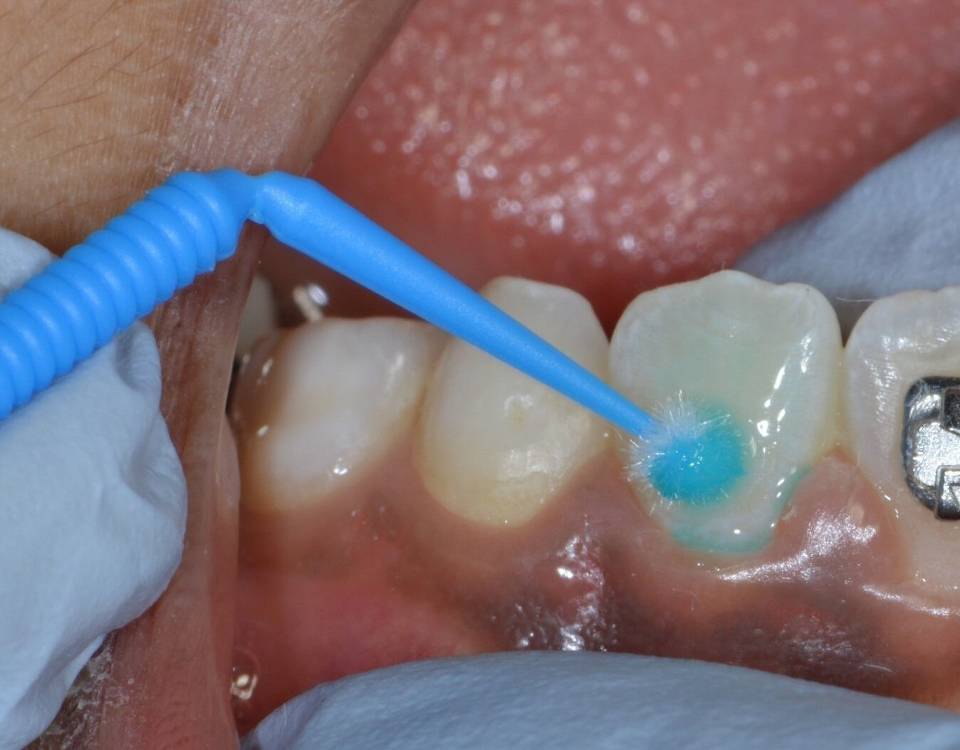 Glass Ionomer Cement Fissure Sealants useful as nonaerosolgenerating