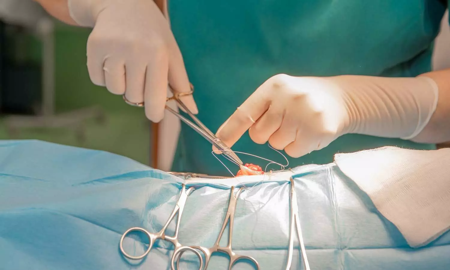 Children with Posterior Urethral Valves Face Persistent Long-Term Risk of CKD: Study Children with Posterior Urethral Valves Face Persistent Long-Term Risk of CKD: Study