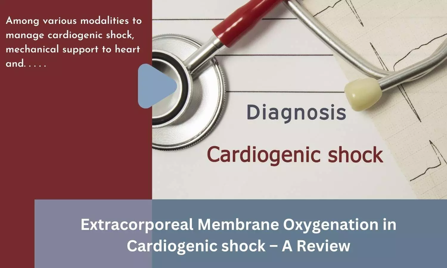 Extracorporeal Membrane Oxygenation in Cardiogenic shock-A Review