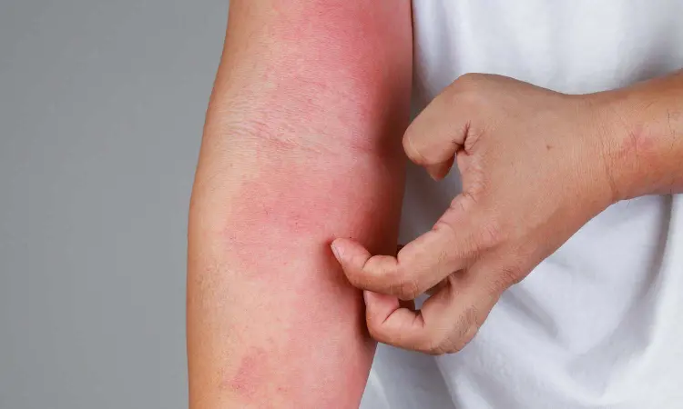 Dupilumab doesnt blunt reproducibility of patch tests in atopic dermatitis