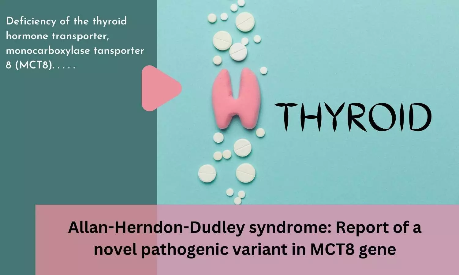 Journal Club - Allan Herndon Dudley syndrome: Report of a novel pathogenic variant in MCT8 gene