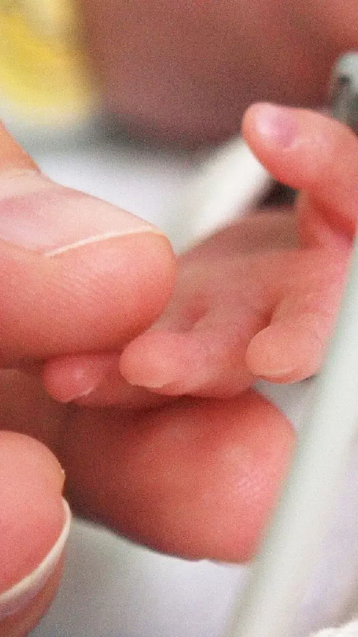 Preconception Diabetes And Prediabetes Linked With Increased Risk Of Preterm Birth