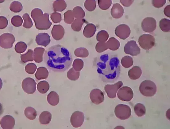 Preoperative neutrophil-lymphocyte ratio- a predictive marker for diagnosis of adnexal torsion