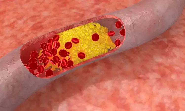 Gut bacteria linked to Subclinical Coronary Atherosclerosis
