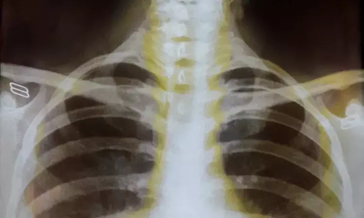 AI detects hidden objects on chest scans better than radiologists, reveals research
