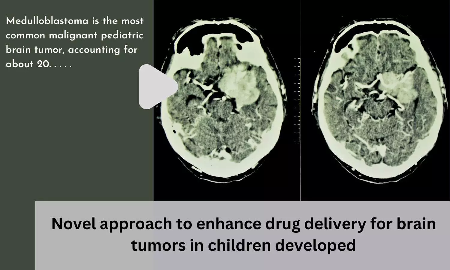 Novel approach to enhance drug delivery for brain tumors in children developed