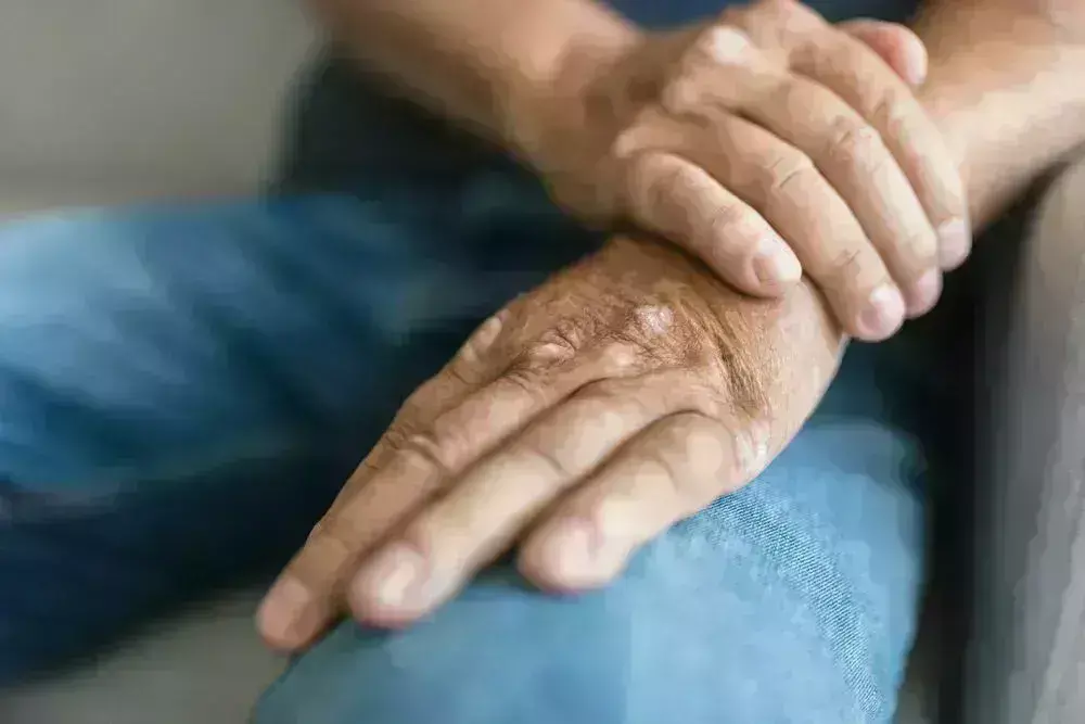 Psoriatic Arthritis Treatment with Apremilast effective and may Improve Patient Satisfactio: Study