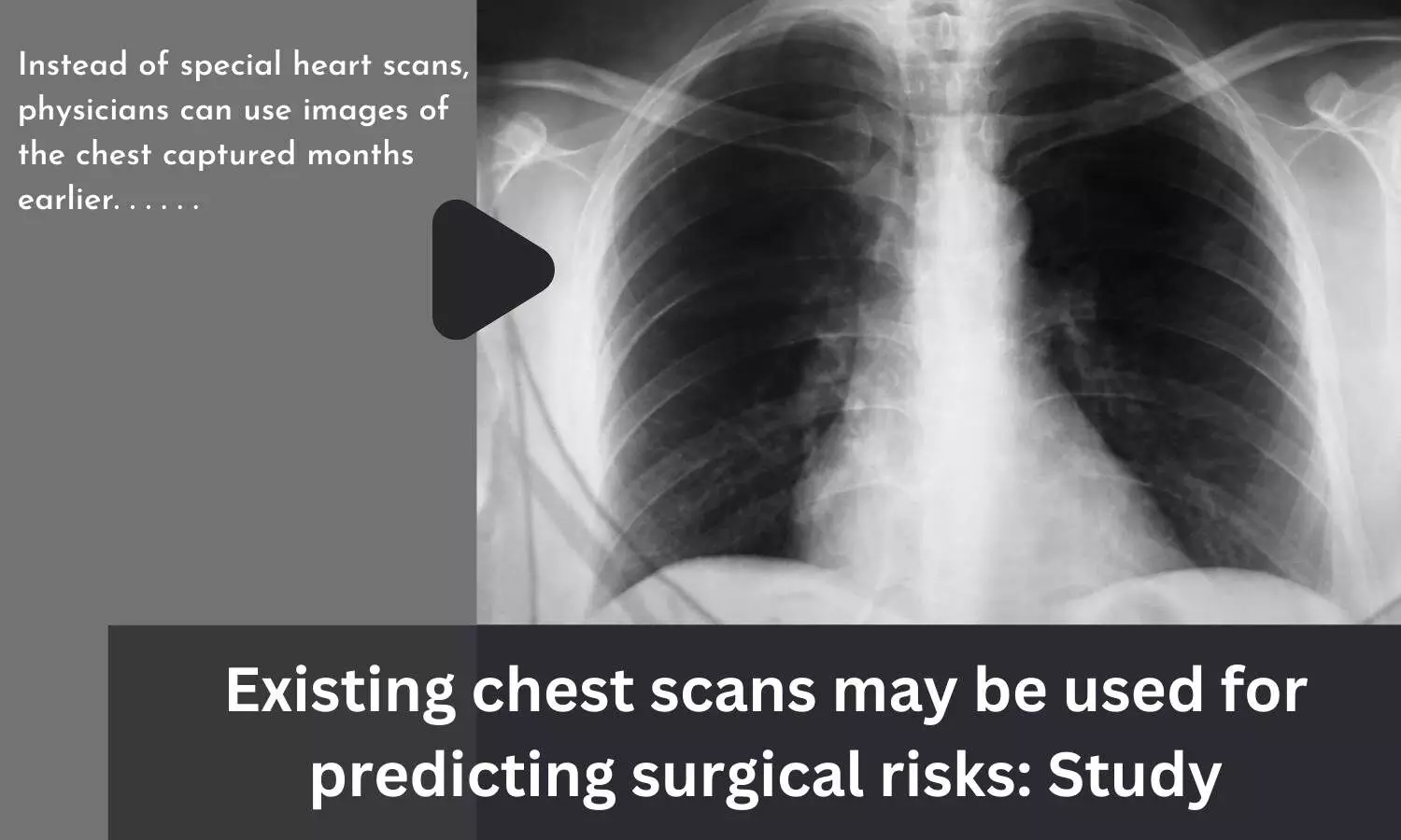Existing chest scans may be used for predicting surgical risks: Study