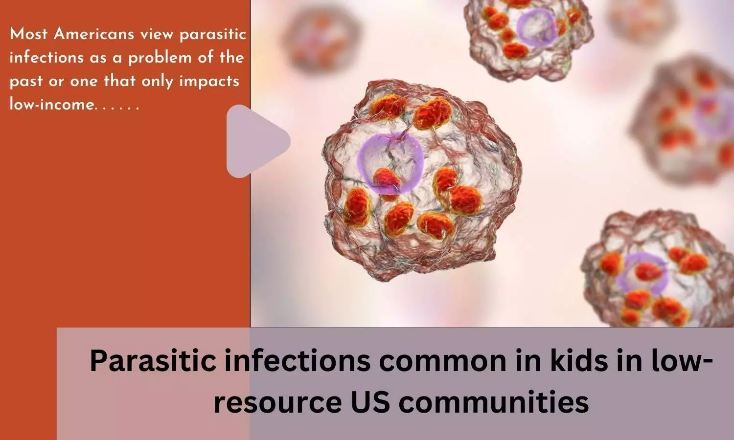 Parasitic infections common in kids in low-resource US communities