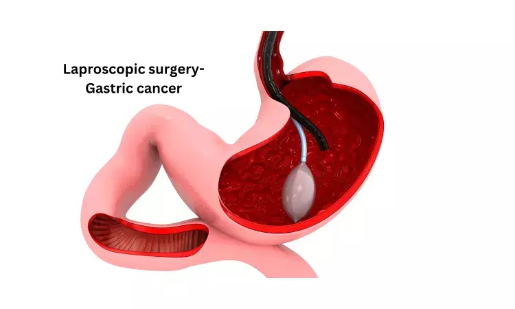 Stomach-Preserving Surgery for Early Gastric Cancer may advance QoL and nutritional outcomes: Study