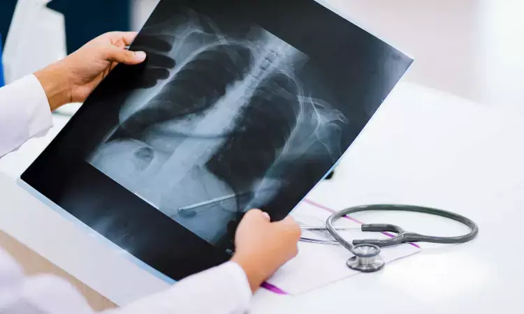 AI software may equal radiologists at spotting tuberculosis from chest X-rays, study finds