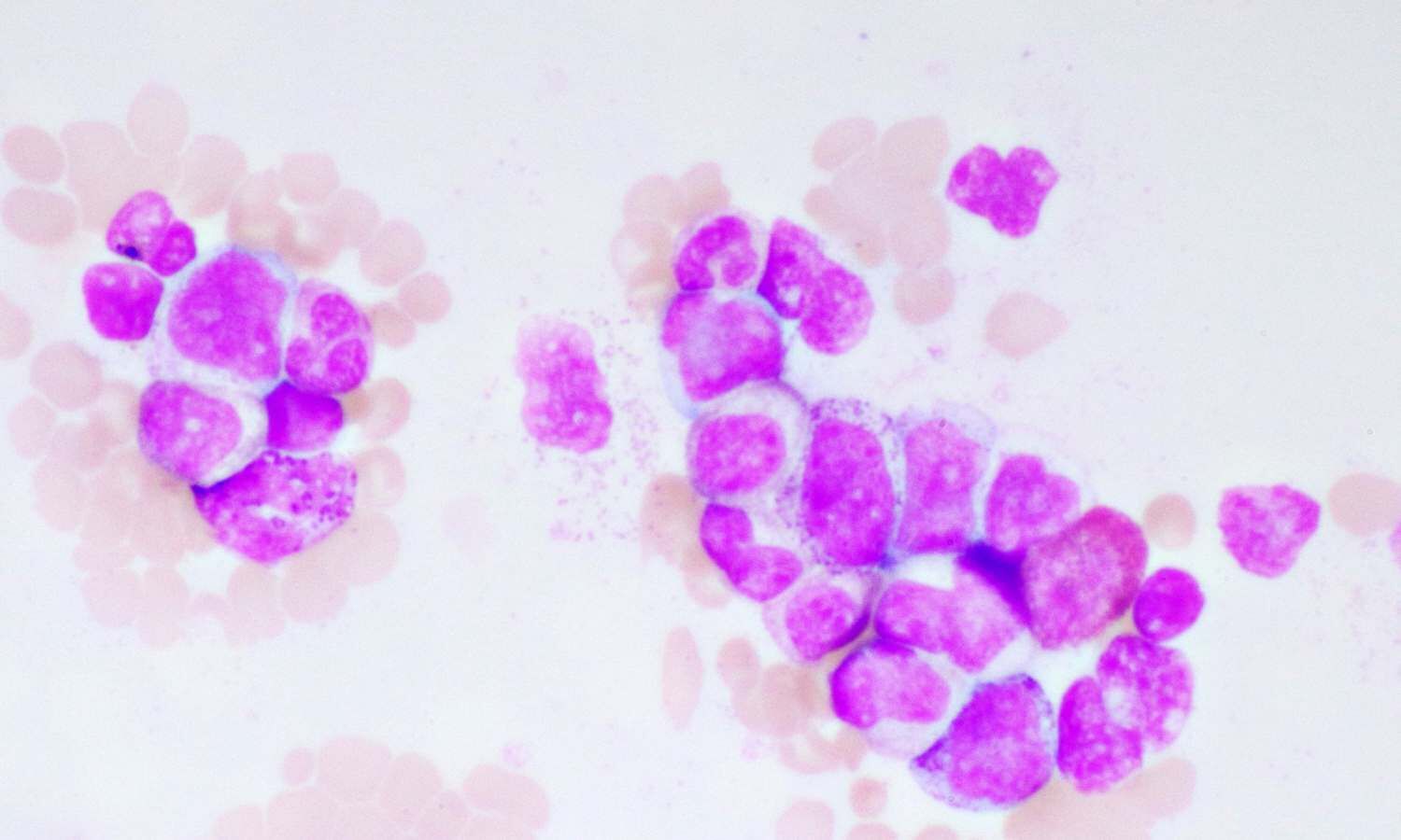 Blood test may predict risk of relapse after bone marrow transplant in ...