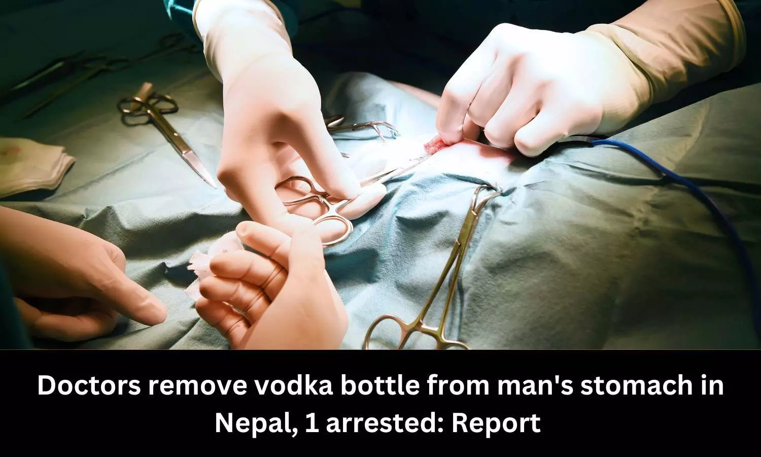 Doctors remove vodka bottle from mans stomach in Nepal, 1 arrested: Report
