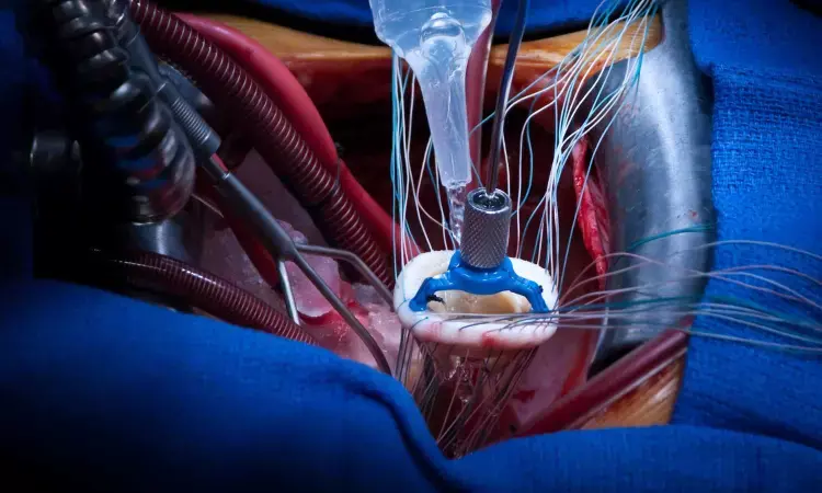 Mitral valve repair through minimally invasive or conventional surgery leads to similar recovery in patients: Study