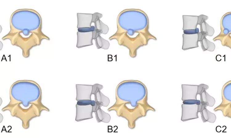 Modified classification system helps predict treatment approach in migrated nucleus pulposus in patients with lumbar disc herniation