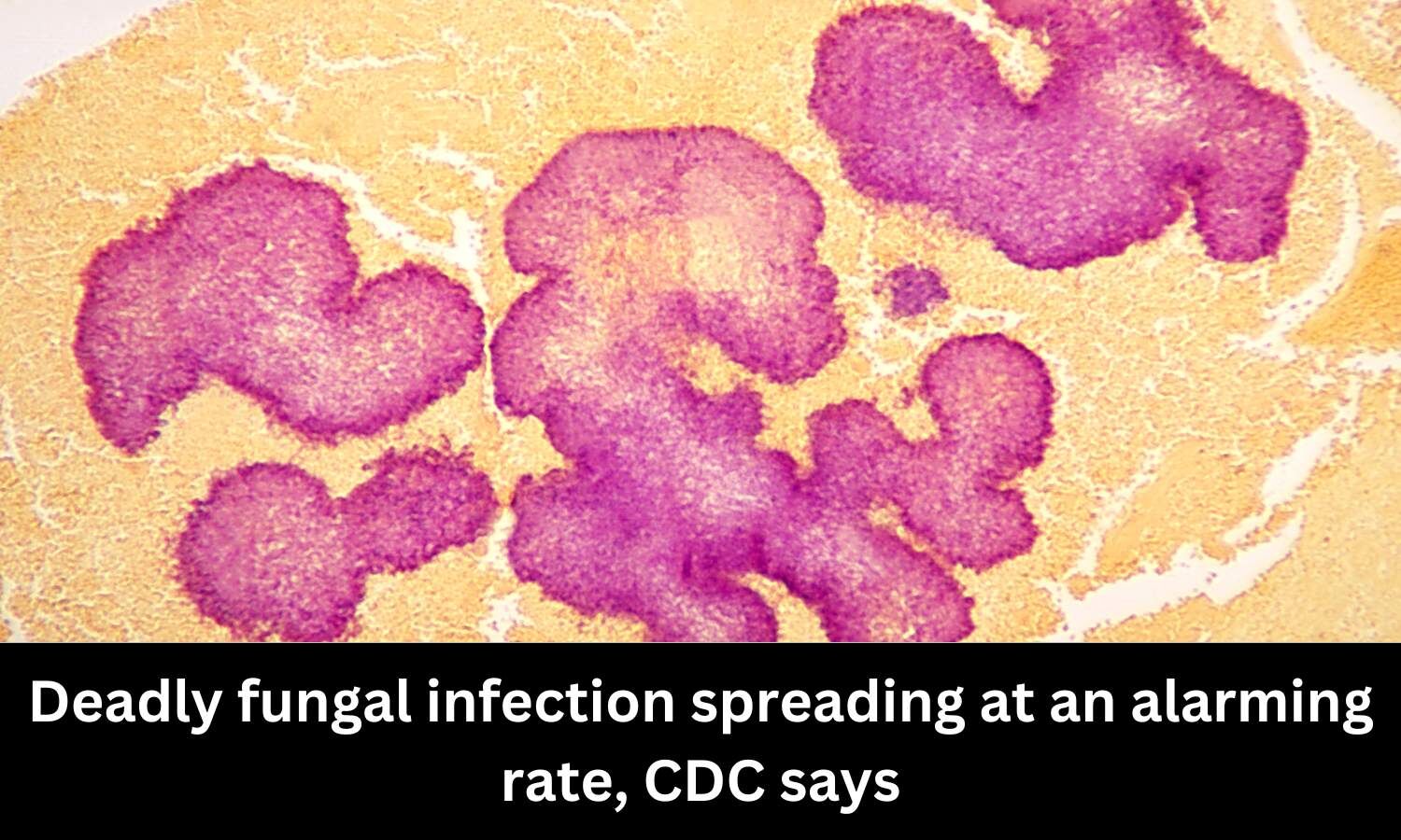Deadly fungal infection spreading at alarming rate CDC